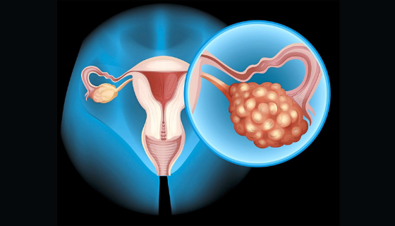 Ovarian Cyst