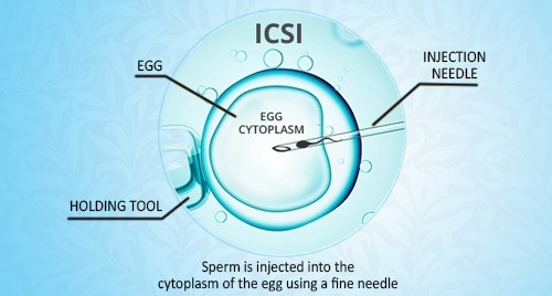 Intracytoplasmic Sperm Injection or Intracytoplasmic Sperm Injection (ICSI/IMSI)