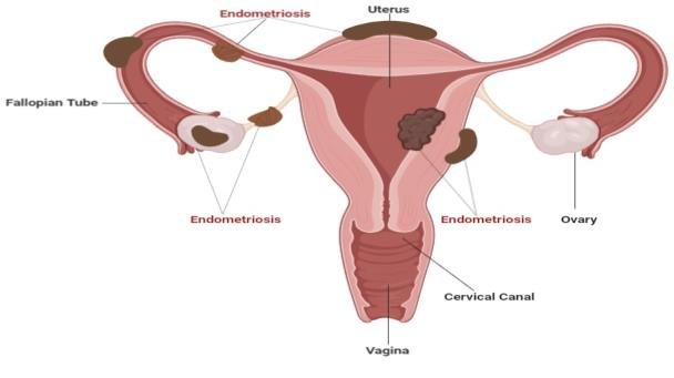 Endometriosis Treatment in Kolkata