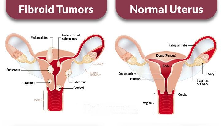 Fibroids Treatment in Kolkata