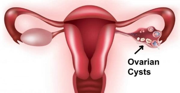 Ovarian Cysts Treatment in Kolkata