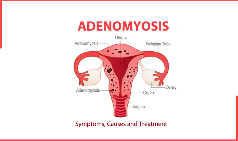 Adenomyosis Treatment in Kolkata
