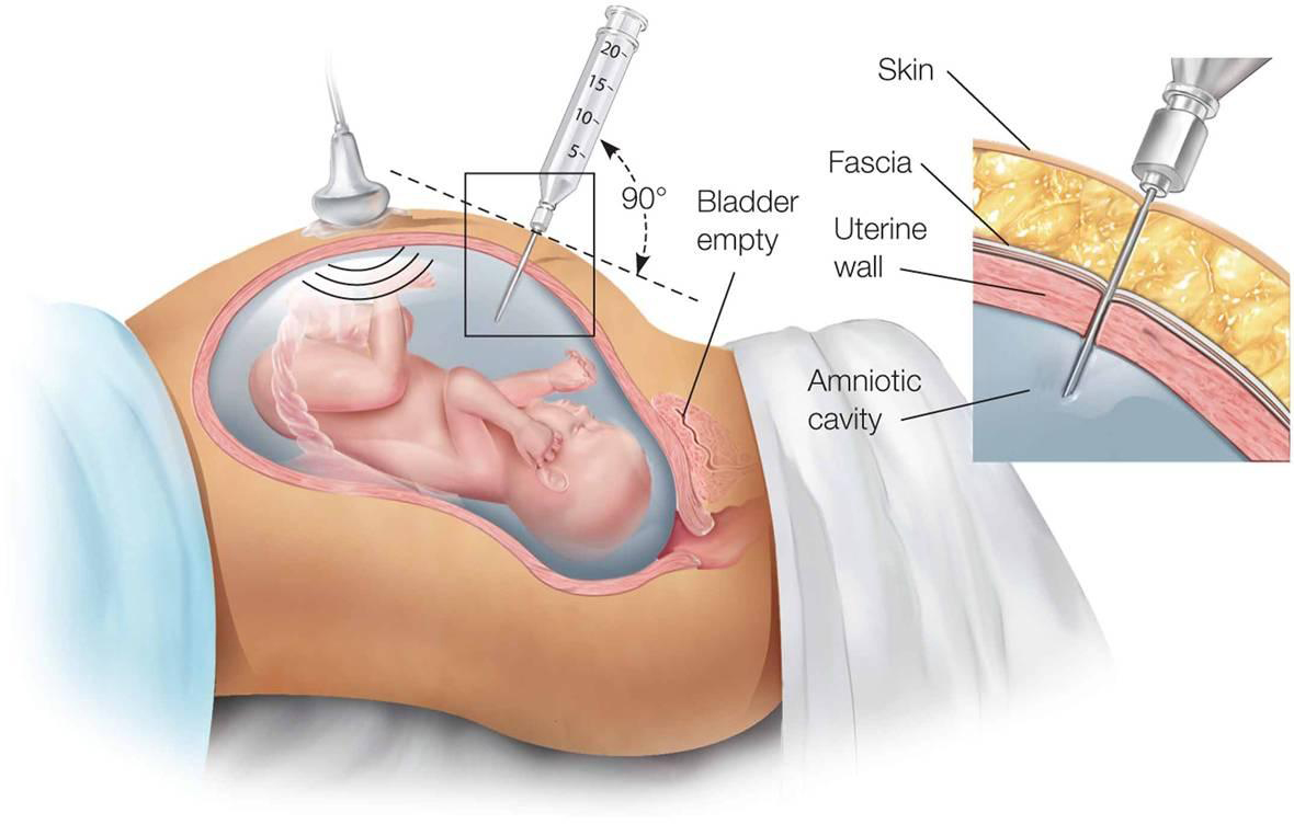Prenatal Diagnosis & Treatment in Kolkata